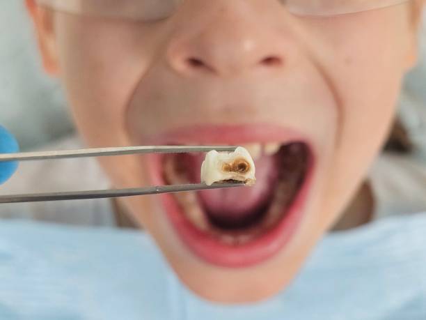 Best Emergency Wisdom Tooth Extraction in Morrisonville, NY